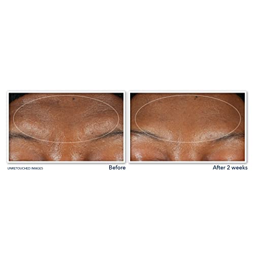 Buy now RoC Retinol Correxion Deep Wrinkle Serum Facial Cleanser with Niacinamide for Anti-Aging & Fine Lines, Makeup Remover, Ophthalmologist Tested Skin Care, 6 oz at indiglob india