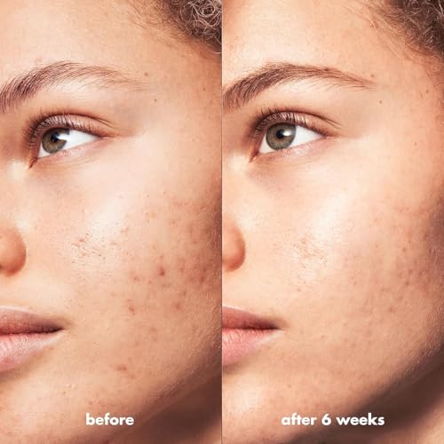 Buy now e.l.f. SKIN Blemish Breakthrough Clarifying Cleanser, Gel Cleanser For Removing Makeup, Controlling Oil & Clarifying Pores, 1% Salicylic Acid at indiglob india