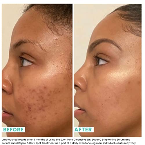 Buy now Urban Skin Rx® Even Tone Cleansing Bar | 3-in-1 Multitasking Treatment Daily Cleanser, Exfoliator, & Mask | Targets Uneven Skin & Improves the Appearance of Dark Spots | Includes Applicator | 2.0 Oz at indiglob india