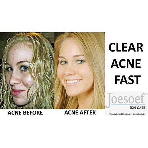 Buy now Joesoef Anti-Acne Soap, Natural Volcanic Sulfur 10%, for Oily to Normal Skin, 3.5-Ounces (Pack of 3) at indiglob india