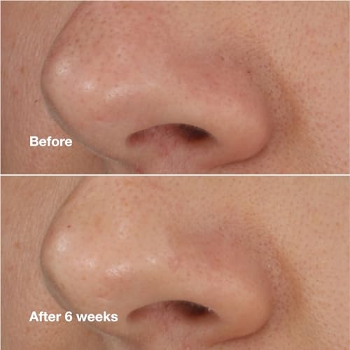 Buy now Clinique Blackhead Solutions Self-Heating Blackhead Remover With Salicylic Acid For All Skin Types, 0.68 Fl Oz at indiglob india