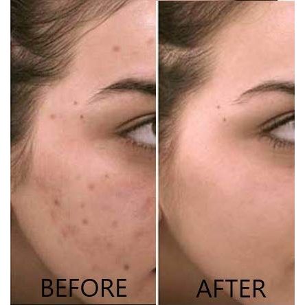 Buy now Vitamin C Serum 20% Pure L-Ascorbic Acid, Ferulic Acid, Vitamin E and Hyaluronic Acid for Face and Eyes Natural Anti Aging Anti Wrinkle 1oz. by Dr. Brenner at indiglob india