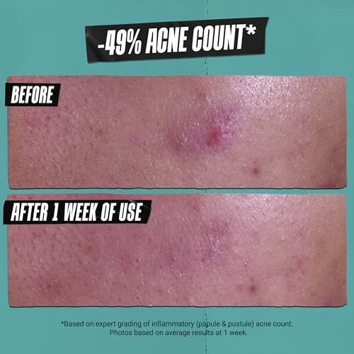 Buy now Kiehlâ€™s Acne-Treating Cleansing Paste, with Salicylic Acid, Multi-Use Product for Cleanser, Spot Treatment, and Face Mask, Non-Drying for All Skin Types, 4.2 Fl. Oz at indiglob india