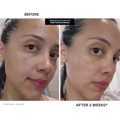 Buy now Kate Somerville EradiKate 3% Sulfur Daily Foaming Cleanser Acne Treatment â€“ Clinically Formulated Medicated Face Wash Balances Skin & Cleans Pores, 4 Fl Oz at indiglob india