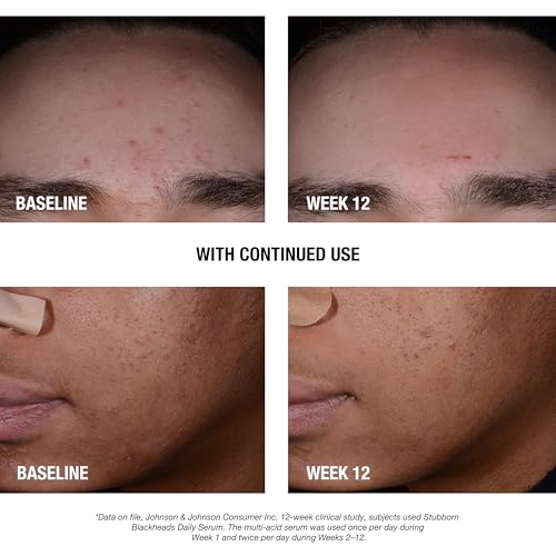 Buy now Neutrogena Stubborn Blackheads Daily Acne Facial Serum with Salicylic, Glycolic, Polyhydroxy & Mandelic Acids, Oil-Free Face Serum for Acne-Prone Skin to Help Clear Clogged Pores, 1 fl. oz at indiglob india
