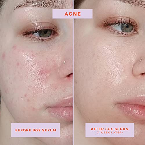 Buy now Tower 28 SOS Rescue Face Serum - Soothing Facial Serum with Hypochlorous Acid for Irritated, Sensitive Skin - Gently Helps Reduce Redness + Blemishes - Fragrance-Free Everyday Skin Care (2 oz) at indiglob india