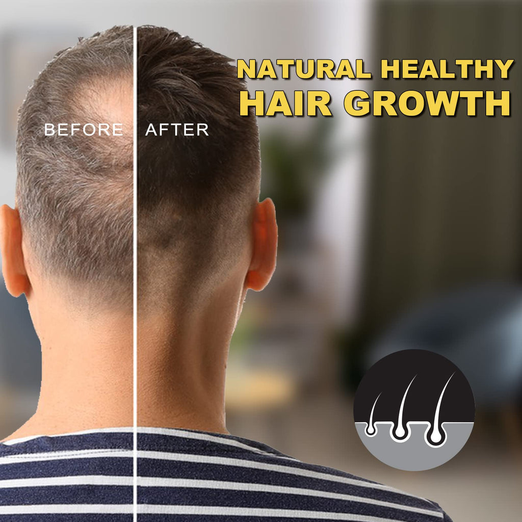 Transform your hair with Minoxidil Hair Growth Serum for natural healthy hair growth. Perfect for daily use. Available at Curat Cart.