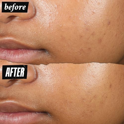 Buy now Kiehl's Truly Targeted Acne-Clearing Pimple Patch with 2% Salicylic Acid, Invisible Liquid Spot Treatment, 4% Niacinamide Fades Post-Acne Marks, 0.2% Licorice Root Soothes Redness - 0.5 fl oz at indiglob india