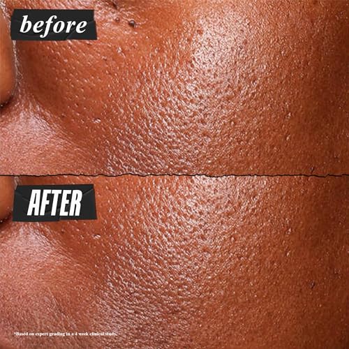 Buy now Kiehl's Ultra Pure High-Potency 5.0% Niacinamide Serum, Concentrated Face Serum for Oily Skin, Reduces Excess Oil and Shine, Helps Minimize Imperfections for a Natural Glow, Paraben-Free - 1 fl oz at indiglob india