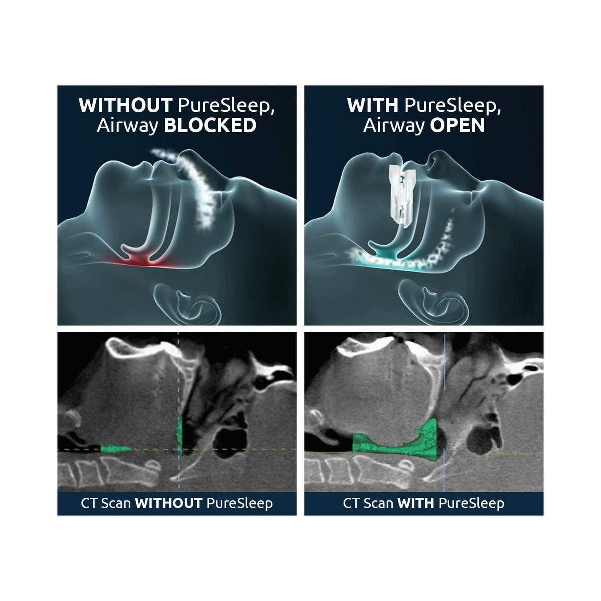 PureSleep - The Original Anti-Snoring Mouthpiece and #1 Solution Worldwide