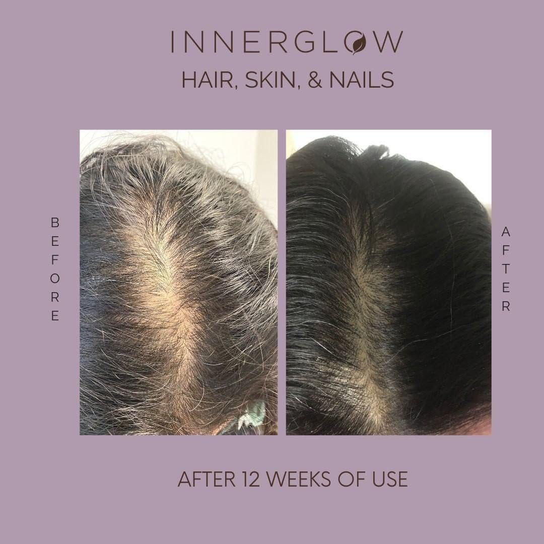 Inner Glow Advanced Hair, Skin & Nails Vitamins – Doctor-Developed Hair Supplement with Biotin, Collagen Peptides, Vitamin D & B12 – Clinically Tested 12-Week Results, Made in USA, Non-GMO