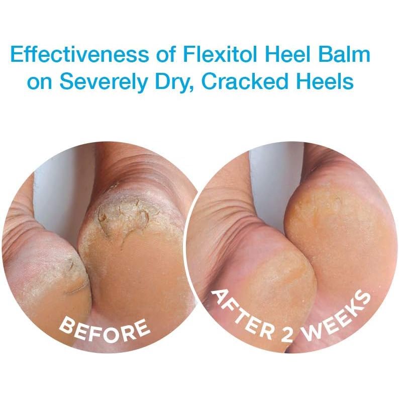 Buy now Flexitol Heel Balm 4 Oz Tube (Pack of 2), Rich Moisturizing & Exfoliating Foot Cream. Fast Relief of Rough, Dry & Cracked Skin on Heels/Feet. For Daily Use and Pedicures. Diabetic Safe and Effective at indiglob india