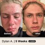 Shield Face Acne System for Men and Boys, Easy 3-Step Clear Skin Kit with 4% Benzoyl Peroxide Face Wash, Adapinoid Spray and Manuka Honey Moisturizer, Clears Breakouts and Balances Oily Skin