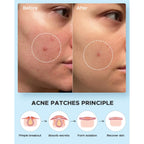 LitBear Acne Pimple Patches- Day and Night 4 Sizes 180 Dots Thin & Thick Hydrocolloid Patches with Witch Hazel, Tea Tree & Calendula Oil, Pimple Stickers for Covering Zits, Blemishes, Spots, Acne Dots