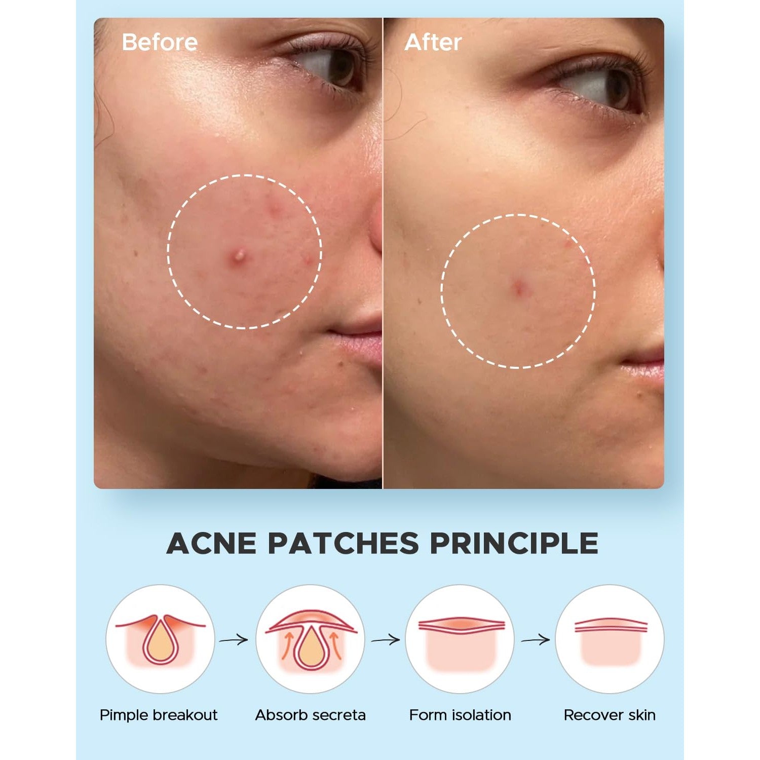 LitBear Acne Pimple Patches- Day and Night 4 Sizes 180 Dots Thin & Thick Hydrocolloid Patches with Witch Hazel, Tea Tree & Calendula Oil, Pimple Stickers for Covering Zits, Blemishes, Spots, Acne Dots
