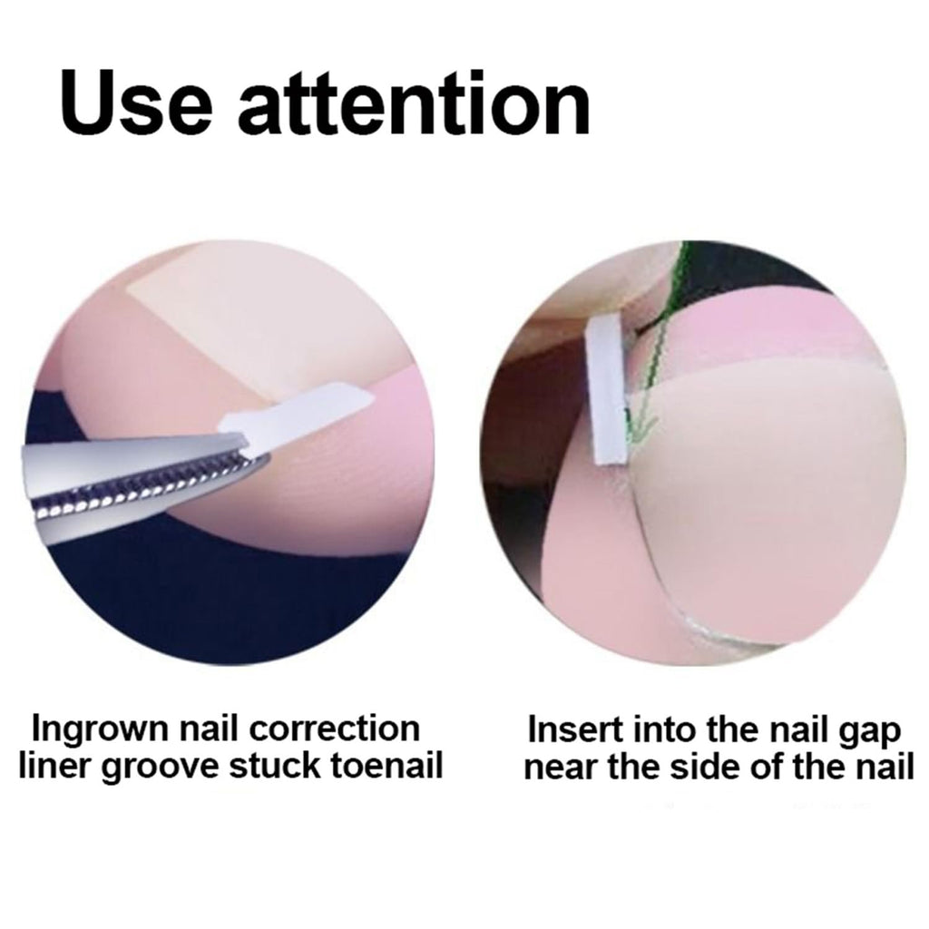 Professional Ingrown Toenail Toolkit, Ingrown Nail Corrector