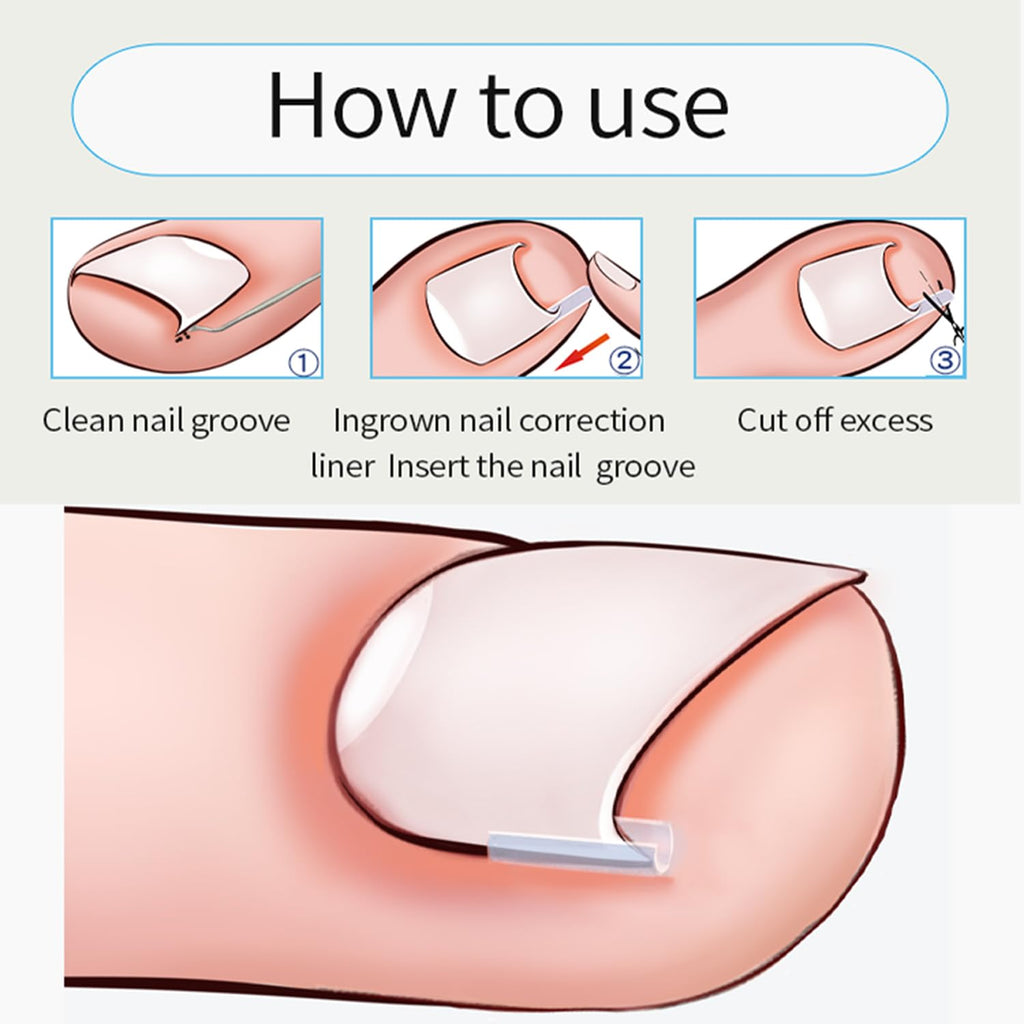 Professional Ingrown Toenail Toolkit, Ingrown Nail Corrector