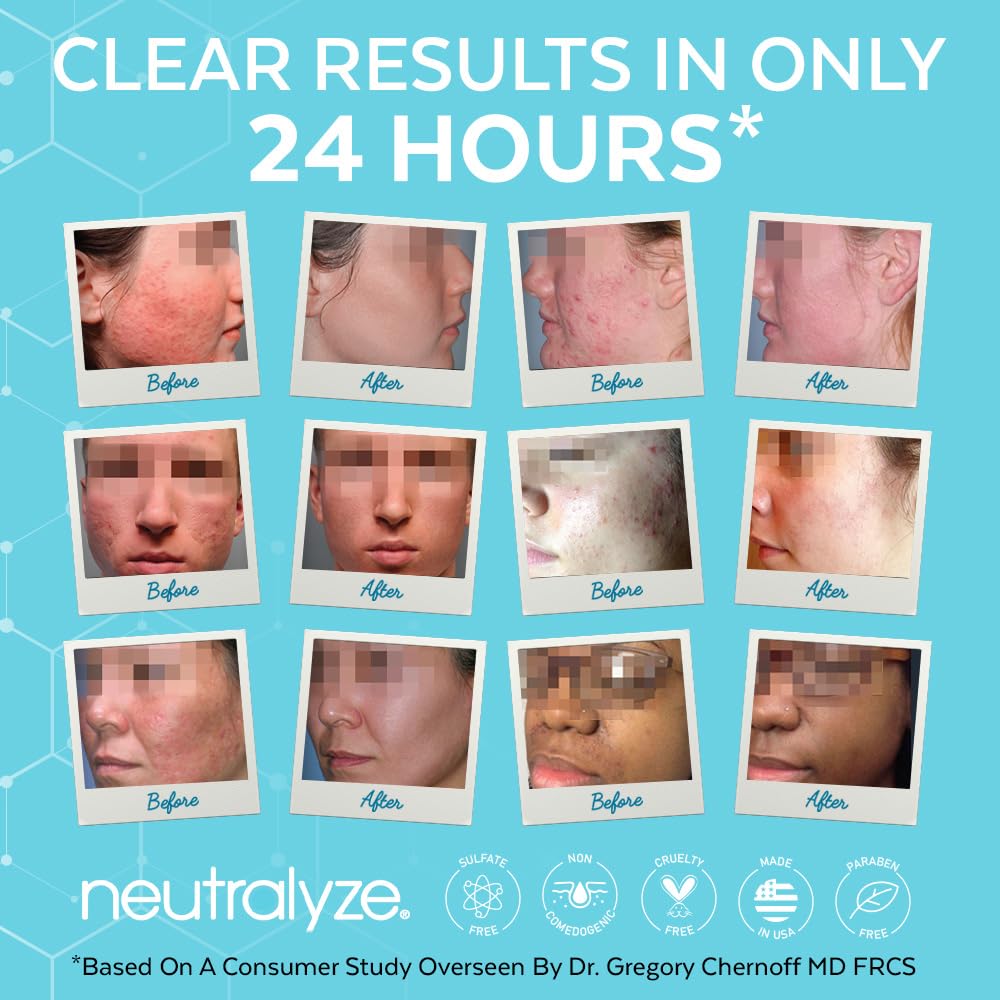 Buy now Neutralyze Exfoliating Acne Treatment Pads (100 Count) - Dual Textured Face Wipes with 2% Salicylic Acid & 2% Mandelic Acid - Toner Pads for Acne Prone Skin, Face & Body Wipes for Teens & Adults at indiglob india