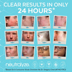 Buy now Neutralyze Exfoliating Acne Treatment Pads (100 Count) - Dual Textured Face Wipes with 2% Salicylic Acid & 2% Mandelic Acid - Toner Pads for Acne Prone Skin, Face & Body Wipes for Teens & Adults at indiglob india