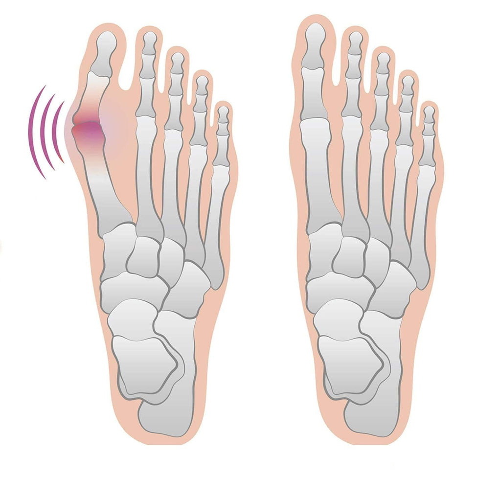 Gel Bunion Relief Sleeves, 2 Pairs
