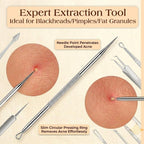 6 Pcs Pimple Popper Tool Kit Blackhead Remover, 410 Grade Stainless Steel | Professional Pimple Extractor Tool Kit for Blackheads, Comedone, Acne, Zit and Whiteheads, Stainless Steel Extraction Tools
