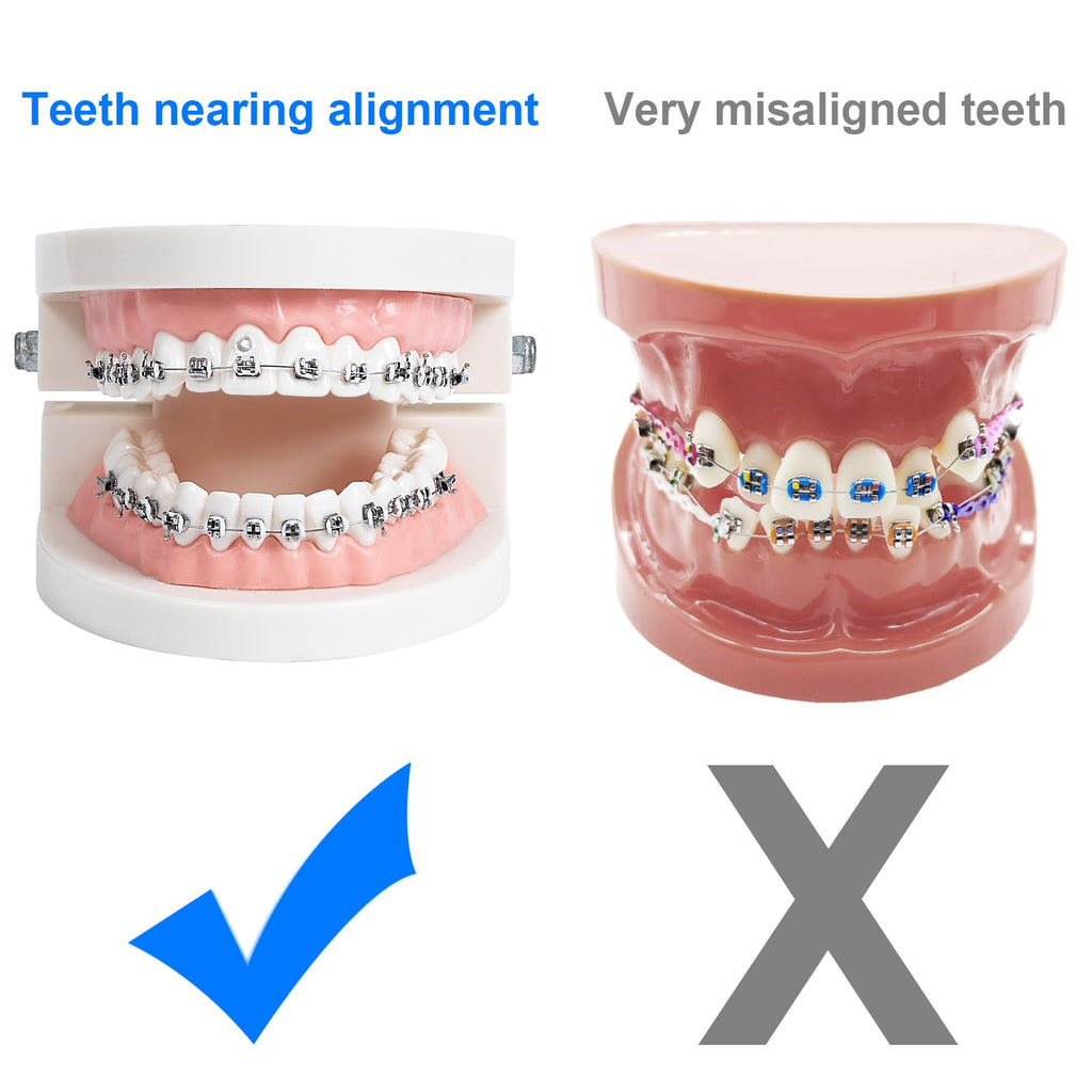 Comfort Cover for Braces, Lip Protector Mouth Guard Lip Cushion Teeth Shield Bumper for Brackets, Aligner, Dental Wax Alternative, Hard and Rigid Clip, in Portable Storage Case with Mirror