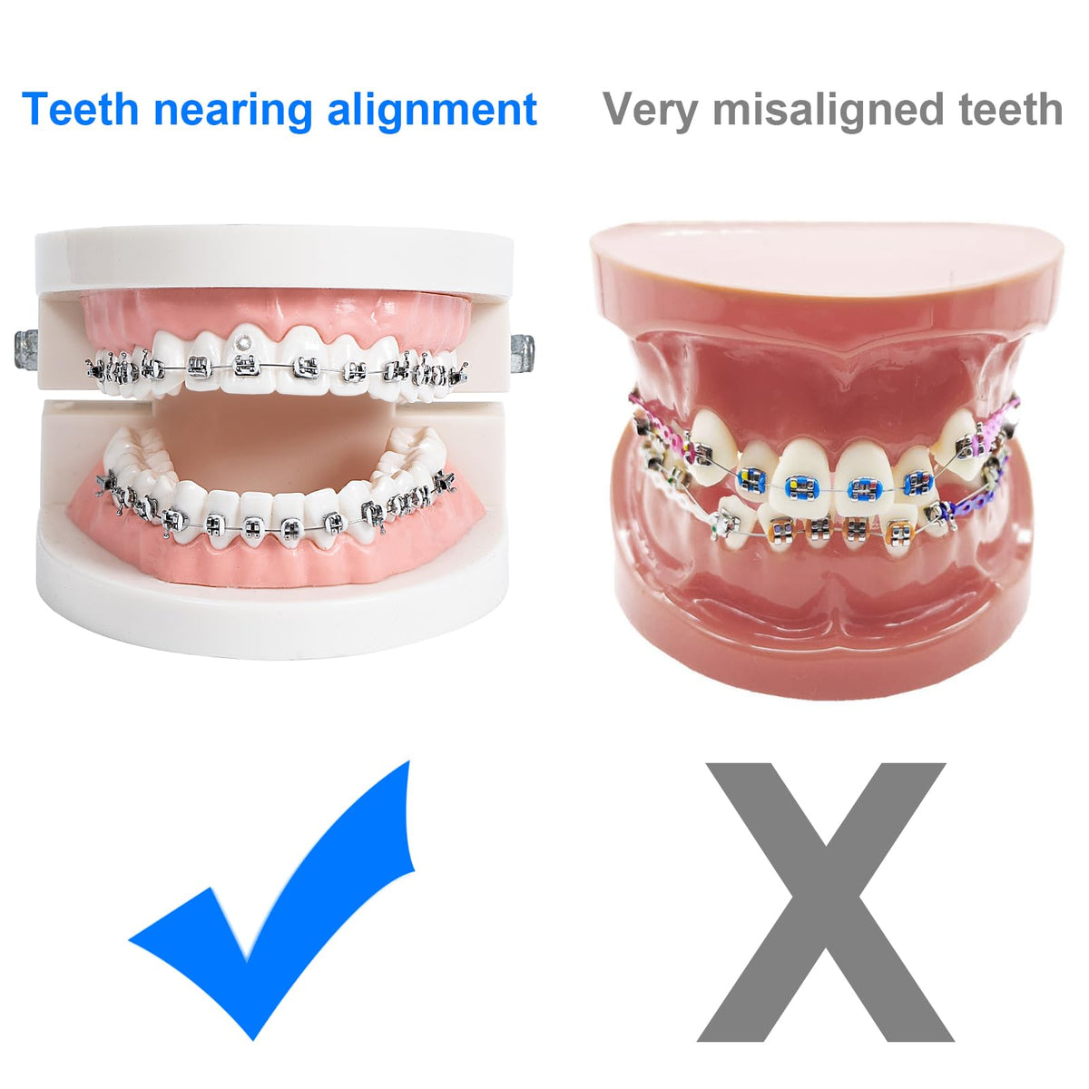 Comfort Cover for Braces, Lip Protector Mouth Guard Lip Cushion Teeth Shield Bumper for Brackets, Aligner, Dental Wax Alternative, Hard and Rigid Clip, in Portable Storage Case with Mirror