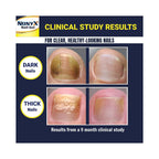 Buy now NONYX Fungal Nail Clarifying Gel | Clinically Proven for Discolored, Thick, Brittle, Yellow, Lifted, and other signs of Fungus-Damaged Toenails | 90% of Nails Improve | Over 8 million sold at indiglob india