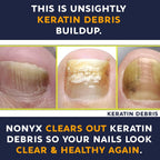 Buy now NONYX Fungal Nail Clarifying Gel | Clinically Proven for Discolored, Thick, Brittle, Yellow, Lifted, and other signs of Fungus-Damaged Toenails | 90% of Nails Improve | Over 8 million sold at indiglob india