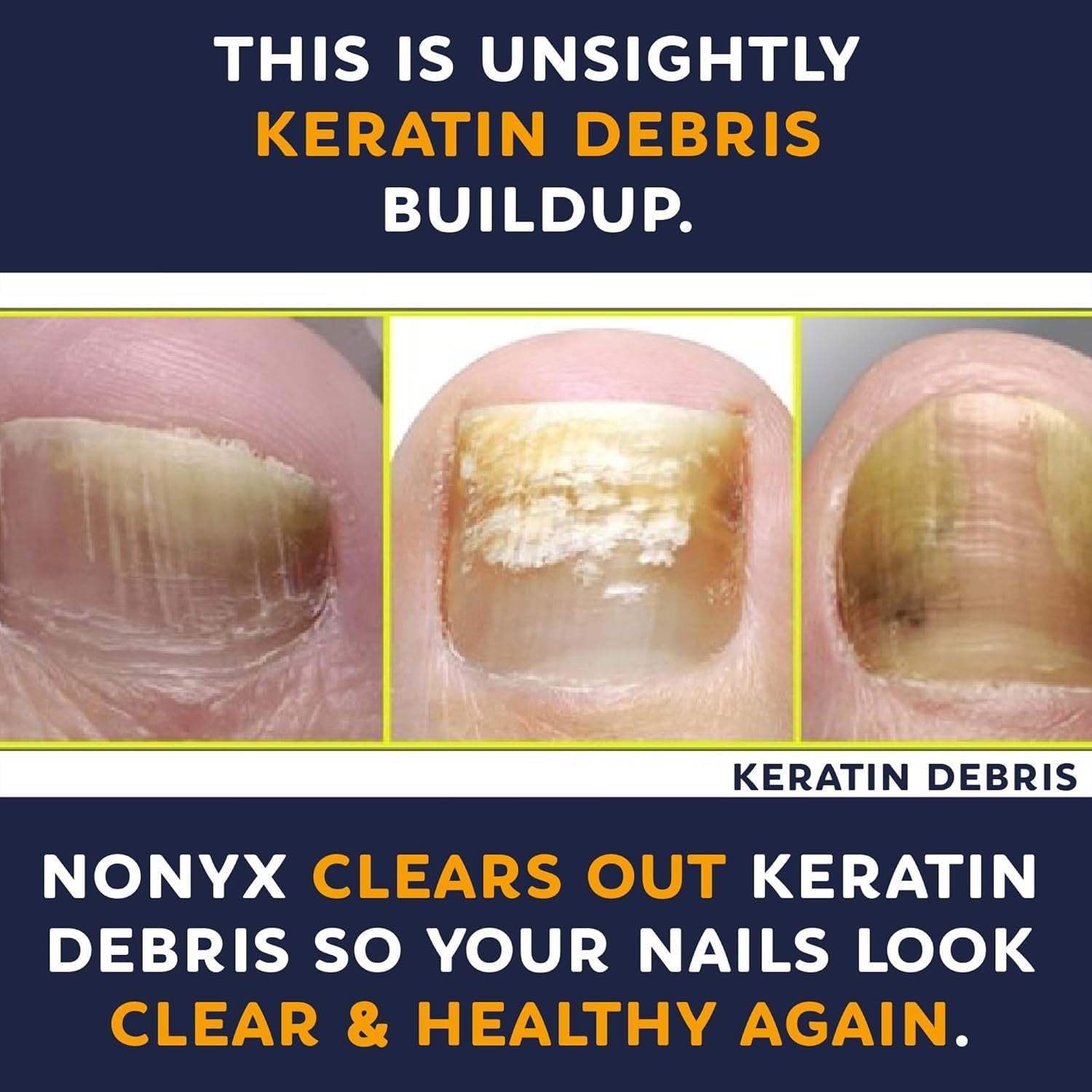 Buy now NONYX Fungal Nail Clarifying Gel | Clinically Proven for Discolored, Thick, Brittle, Yellow, Lifted, and other signs of Fungus-Damaged Toenails | 90% of Nails Improve | Over 8 million sold at indiglob india