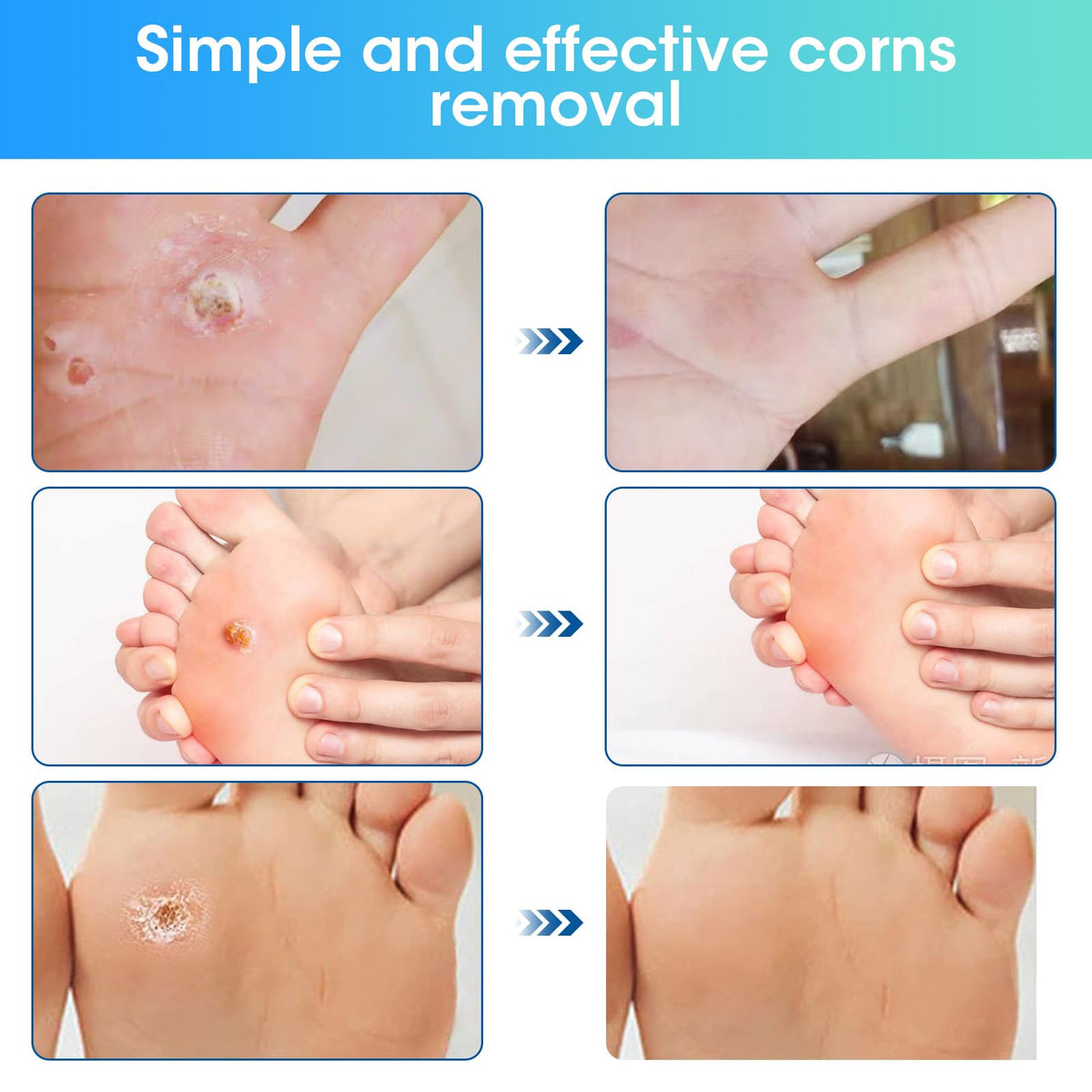 38 Pcs Corn Removal Pads for Toe,Extra Strength Corn & Callus Remover for Feet & Toes for Adult and Elderly Nurses Hikers and Athletes Men and Women