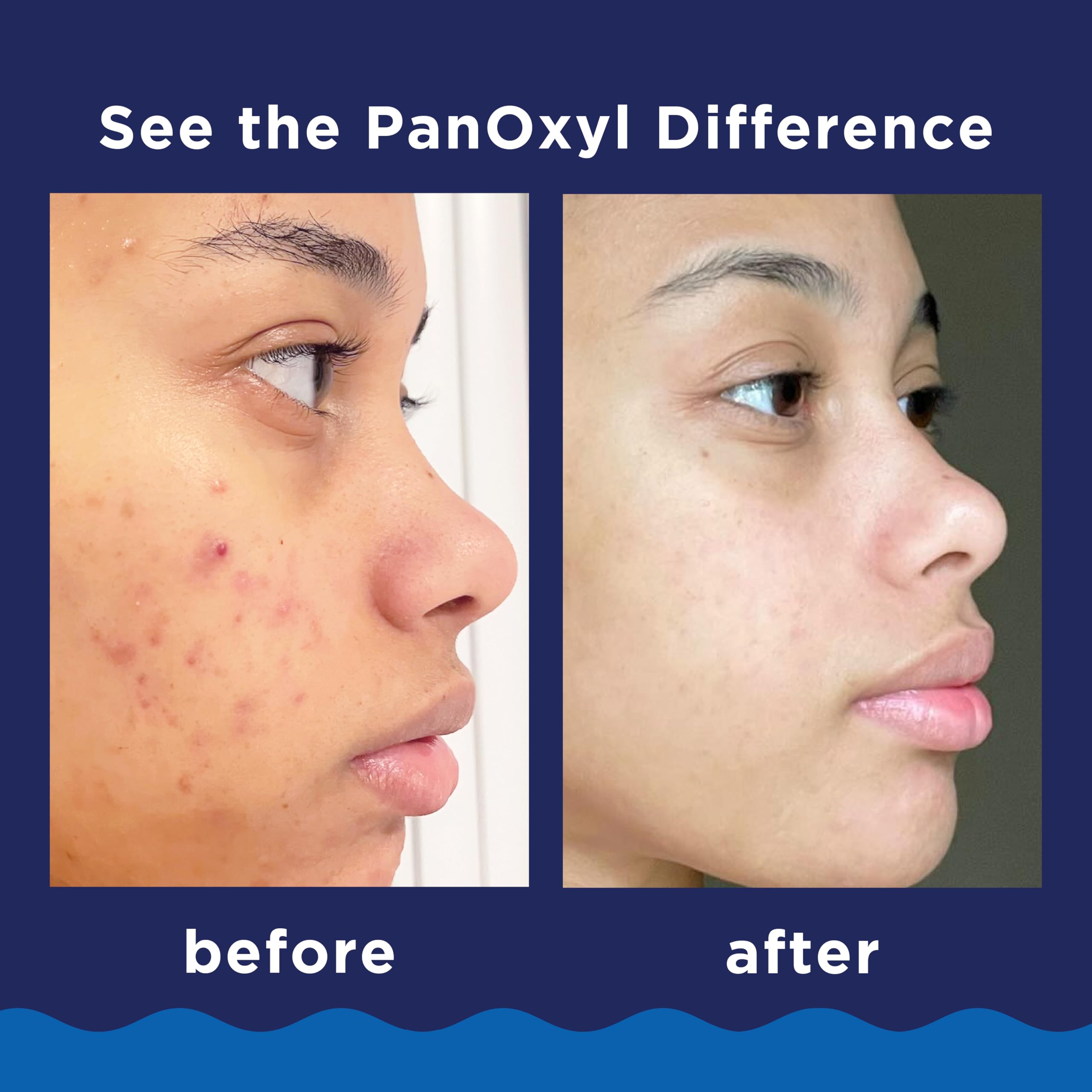 Buy now PanOxyl 10% Benzoyl Peroxide Acne Foaming Wash, Maximum Strength, Daily Acne-Fighting Face and Body Cleanser, Face Wash to Clear, Treat and Prevent Acne Pimples and Stubborn Breakouts, 5.5 Oz Tube at indiglob india