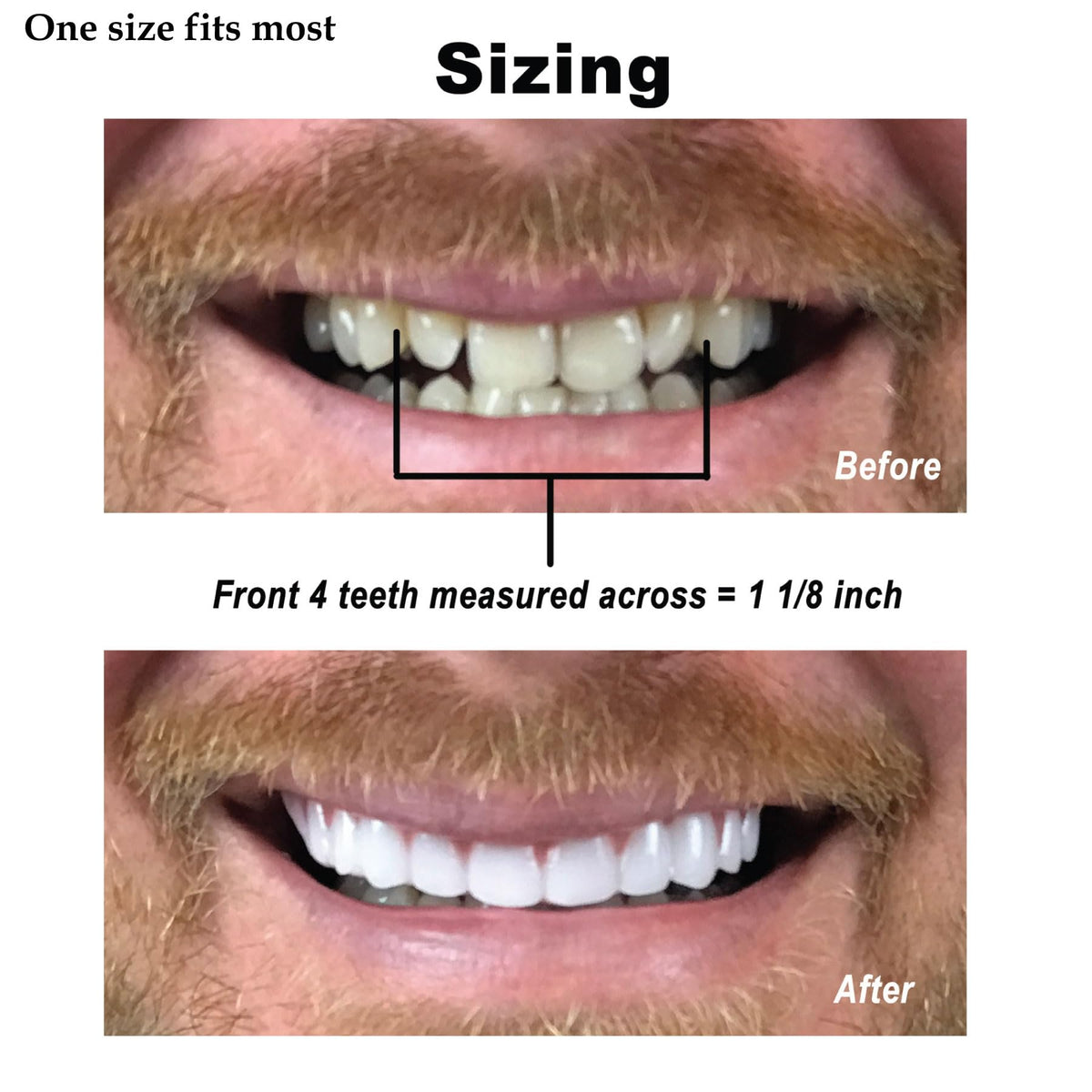 Instant Smile Comfort Fit Flex - Bright Shade - Upper Veneer Cosmetic Teeth