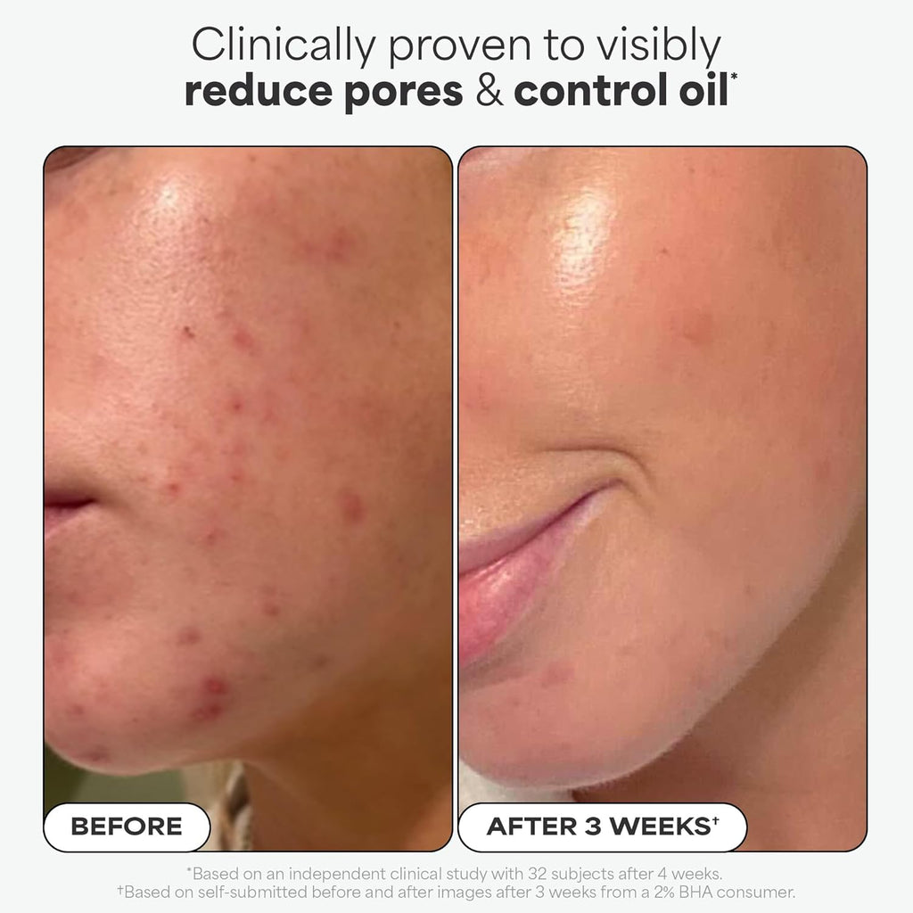 Buy now Paula's Choice SKIN PERFECTING 2% BHA Liquid Exfoliant with Salicylic Acid, Facial Polish for Enlarged Pores, Wrinkles & Fine Lines, Suitable for Blackhead-Prone Skin, Fragrance-Free at indiglob india