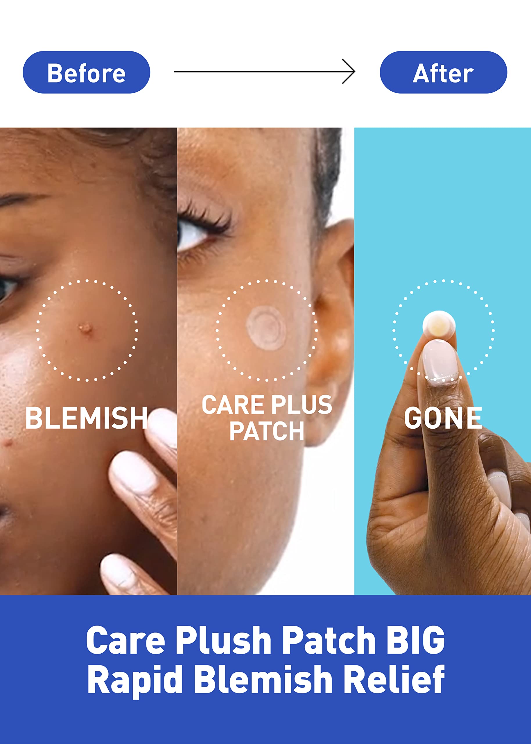 Buy now OLIVE YOUNG Care Plus Spot Patch Big (81 Count) | Hydrocolloid Patch, Spot Stickers for Acne Pimple and Zits at indiglob india