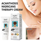Acanthosis Nigricans Therapy Cream,Dark Spot Remover For Body,Dark Spot Corrector Cream,- Underarm, Neck, Armpit, Knees, Elbows, Private Areas, Intimate Areas - Upgraded Formula, - 2.1Fl Oz