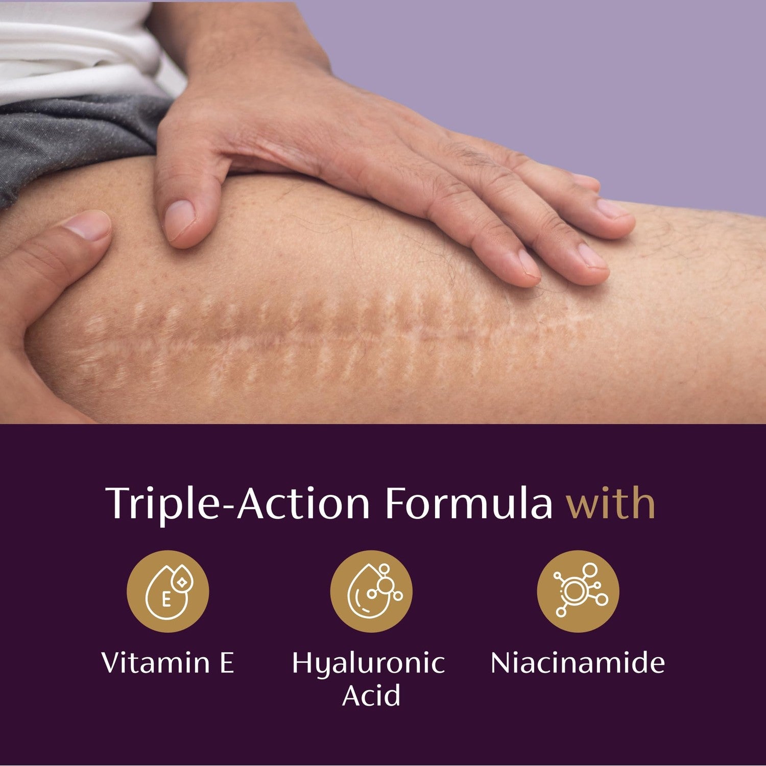 Mederma Scar Serum – Triple-Action Formula with Vitamin E, Hyaluronic Acid & Niacinamide – Clinically Shown to Reduce Old Scars, 1 Fl. Oz.