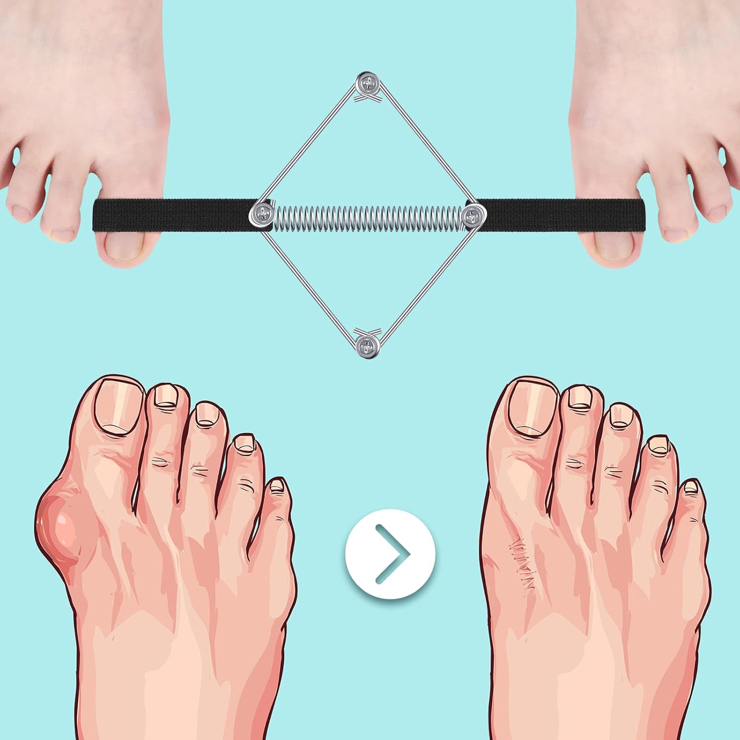 Buy now Pilates Toe Stretcher Bunion, Hallux Valgus Big Toe Strap Spacer Tension Bunion Exercise Band Stretchy Alignment Splint Restores Pain Relief for Women Men at indiglob india