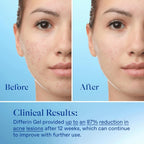 Buy now Differin Acne Treatment Gel, 30 Day Supply, Retinoid Treatment for Face with 0.1% Adapalene, Gentle Skin Care for Acne Prone Sensitive Skin, 15g Tube (Packaging May Vary) at indiglob india