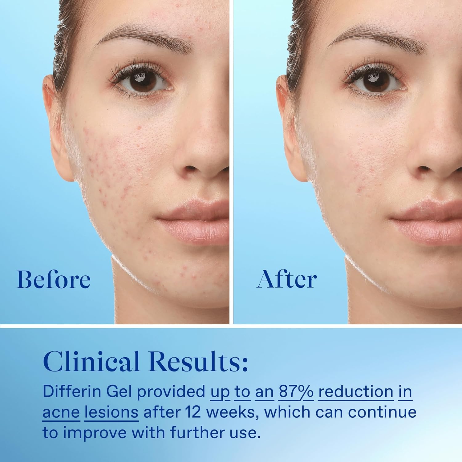 Buy now Differin Acne Treatment Gel, 30 Day Supply, Retinoid Treatment for Face with 0.1% Adapalene, Gentle Skin Care for Acne Prone Sensitive Skin, 15g Tube (Packaging May Vary) at indiglob india