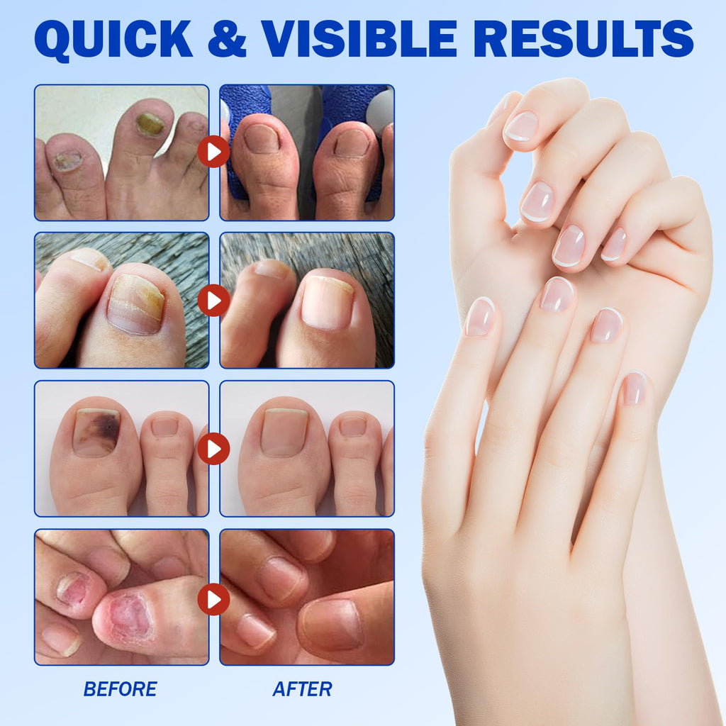 Nail Patches 21 PCS, Toenail Treatment Extra Strength 8-Hour Overnight Nail Fast Acting Repair Effortless Hydrogel Nail Care and Repair for Damaged Nails Overnight Renewal for Men and Women
