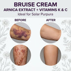 Bruise Cream, Vitamin K & Arnica Cream for Seniors with Thin Skin - Enhanced with Vitamin C & E for Skin Renewal, 4 Oz