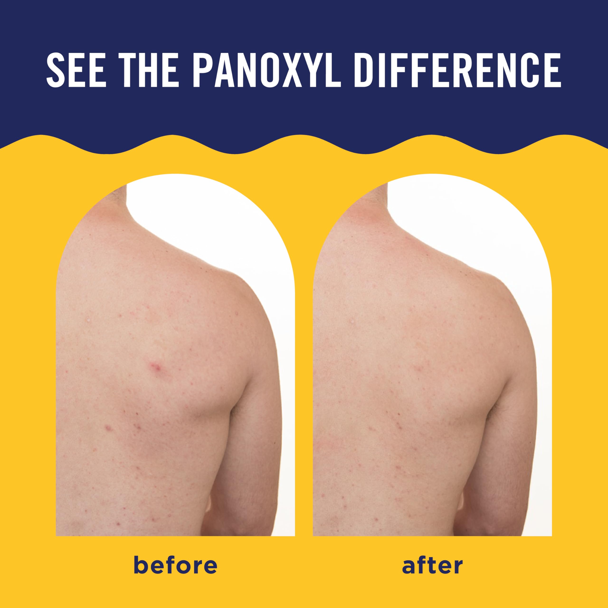 PanOxyl Acne Banishing Body Spray, 2% Salicylic Acid, For Body, 6 oz