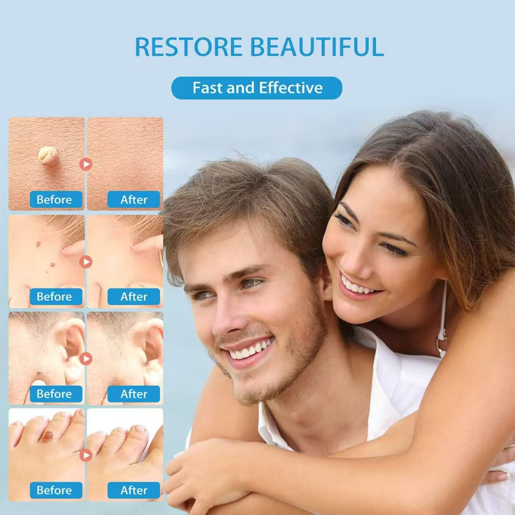 Skin Tag Remover Device Safe and Effective Skin Tag Removal Kits Home Use for Men & Women