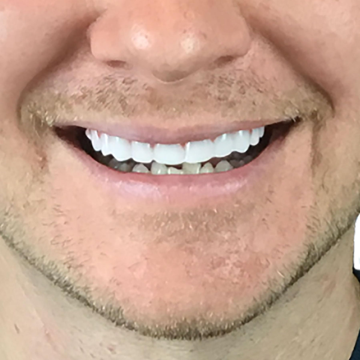 Instant Smile Comfort Fit Flex - Bright Shade - Upper Veneer Cosmetic Teeth
