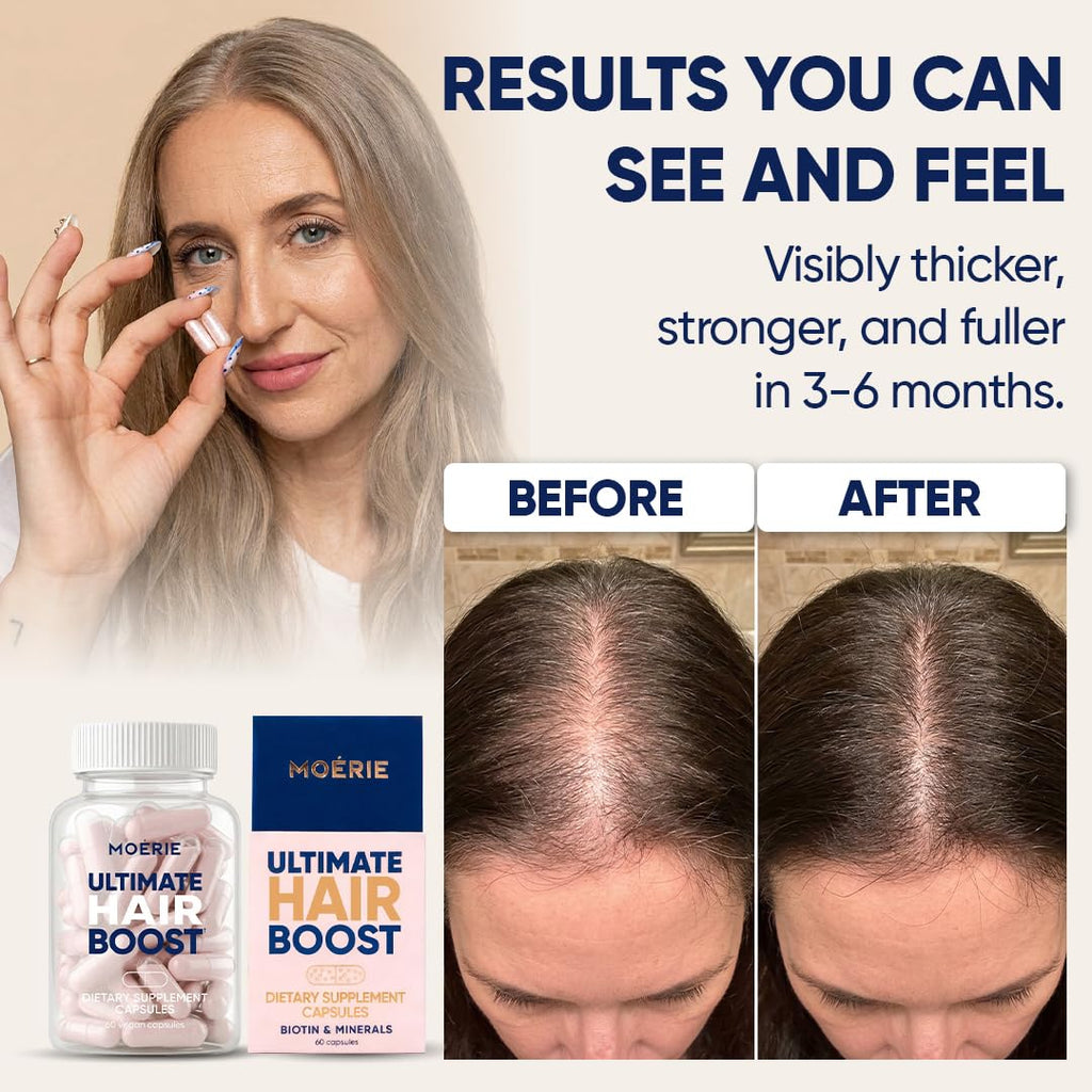 Moerie Ultimate Hair Boost Supplements for Women & Men - Hair, Skin, Nails Vitamins with Biotin & Minerals for Hair Health - Thicker Hair - 180 Capsules
