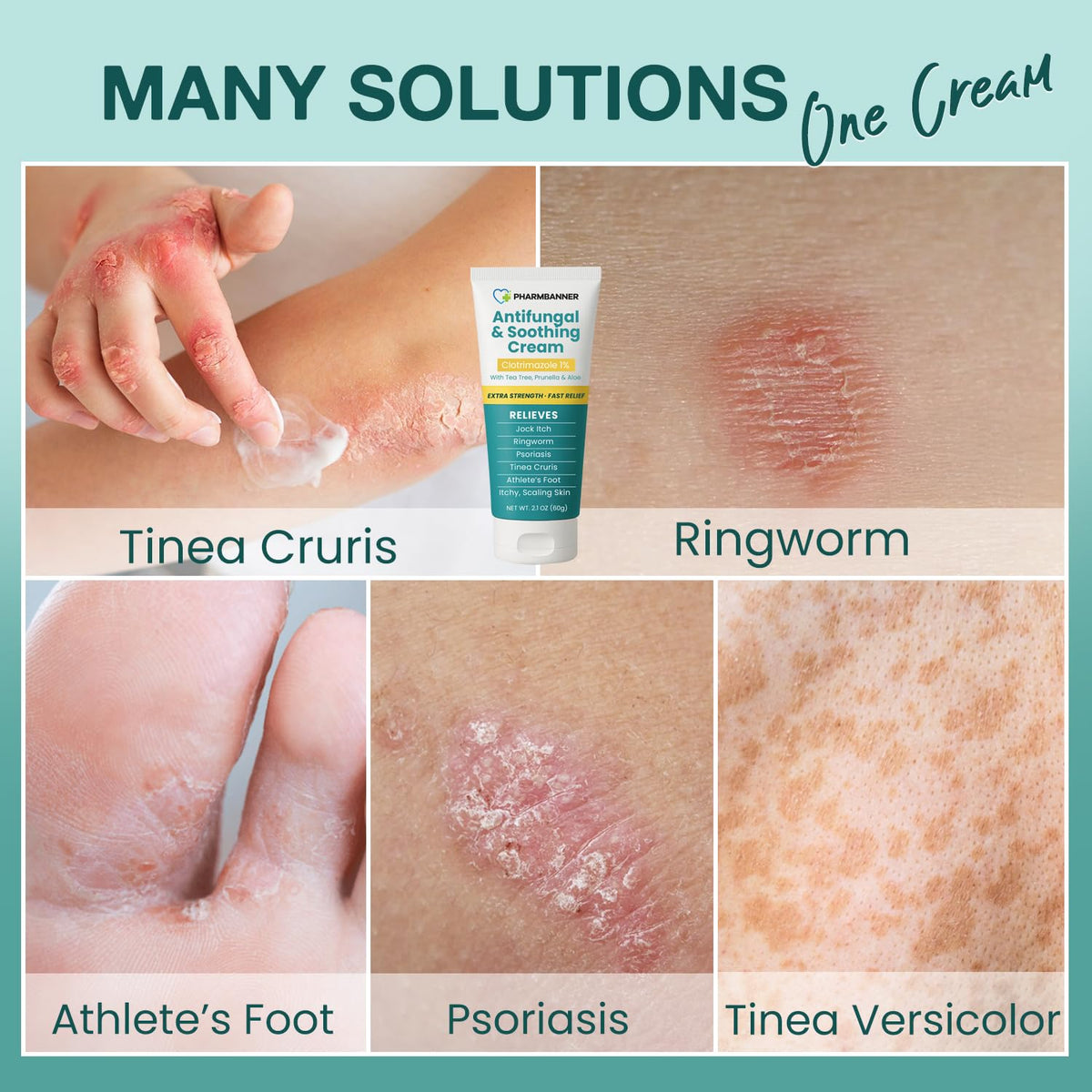 Antifungal Cream for Jock Itch, Ringworm, Psoriasis & Athlete’s Foot – Extra Strength Relief for Itchy, Burning Skin – Fast-Acting Formula for Tinea Cruris, Tinea Versicolor & Skin Irritations