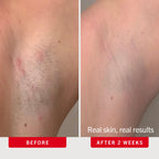 First Aid Beauty Ingrown Hair Pads Aftershave Treatment to Help Prevent Razor Bumps, Exfoliate Underarms & Bikini Area, Sensitive Skin