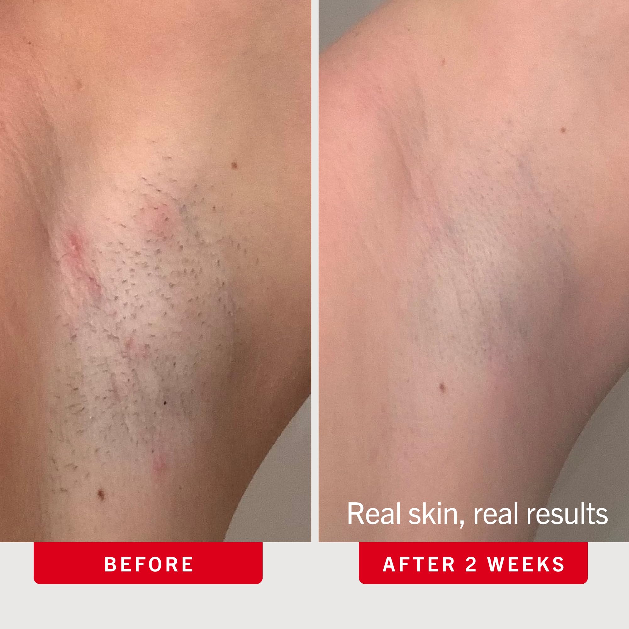 First Aid Beauty Ingrown Hair Pads Aftershave Treatment to Help Prevent Razor Bumps, Exfoliate Underarms & Bikini Area, Sensitive Skin