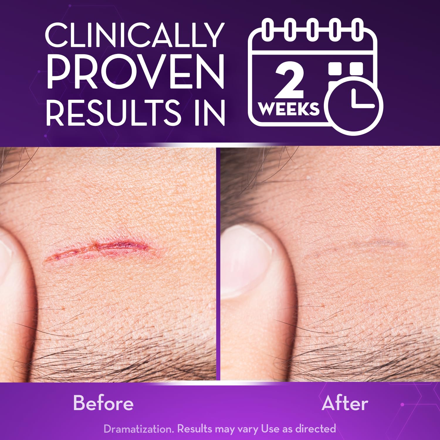 Buy now Cicatricure Advanced Scar Gel for Face & Body - Proven Results in 2 Weeks, Scar Treatment for Surgical Scars, Stretch Marks, Scars of Burns and Injuries, Acne Scar Treatment, 1 oz (28 g) at indiglob india